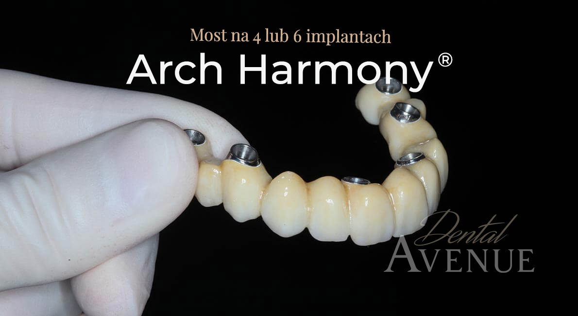 proteza na 4 implantach arch harmony
